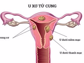 Nguyên nhân gây u xơ tử cung là gì?